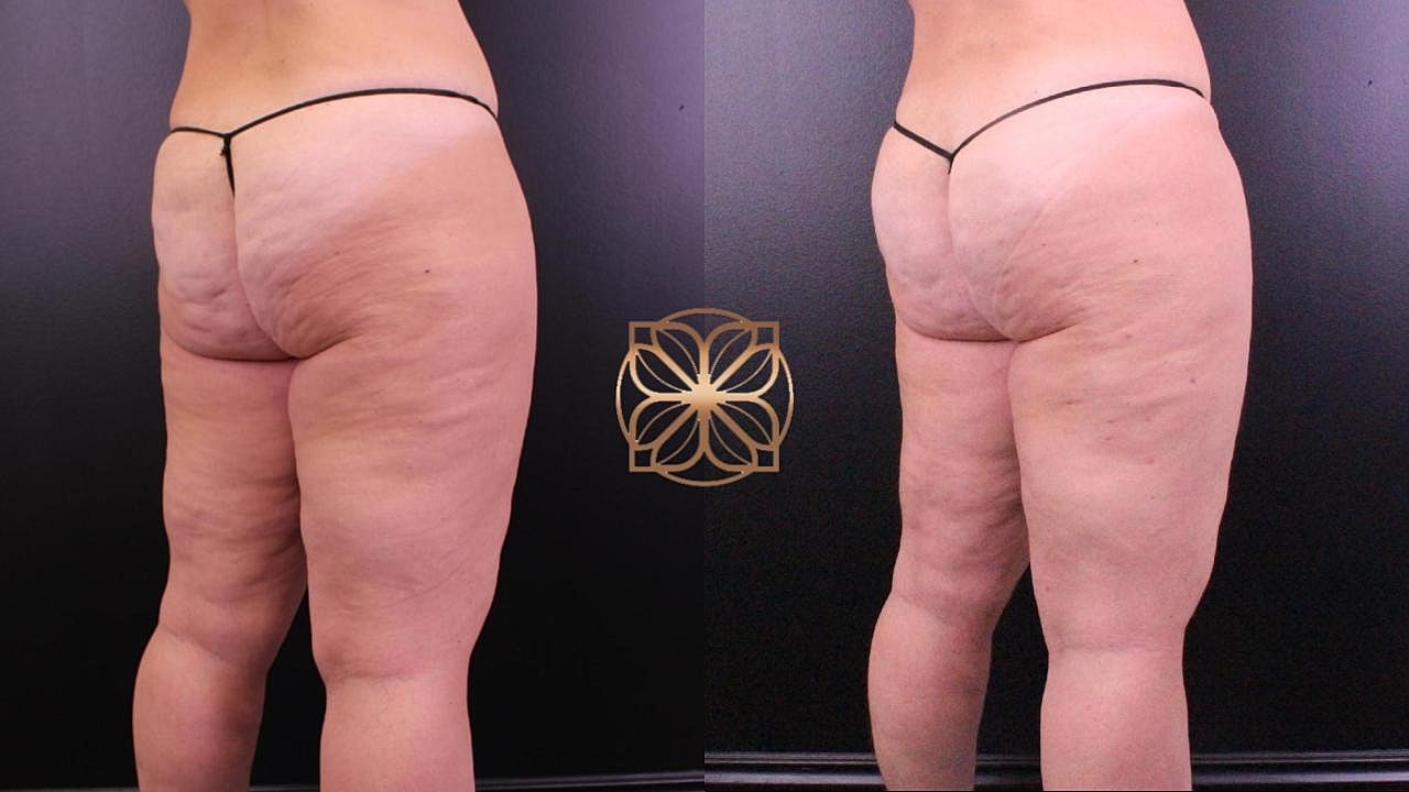 Coolsculpting Gallery Before & After