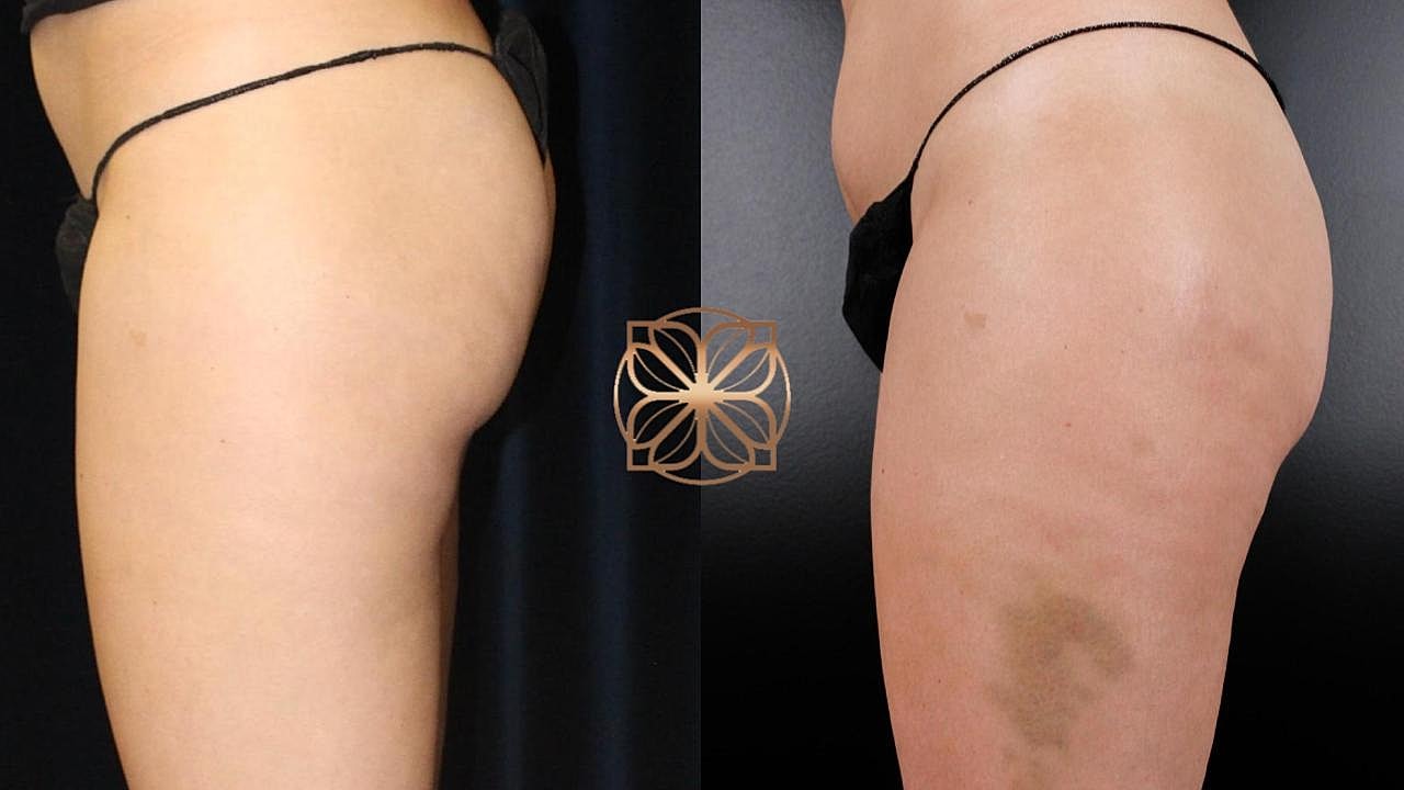 Coolsculpting Gallery Before & After