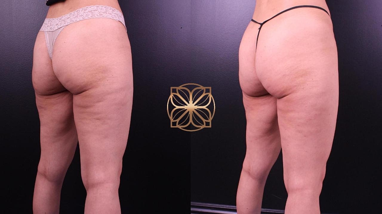 Coolsculpting Gallery Before & After