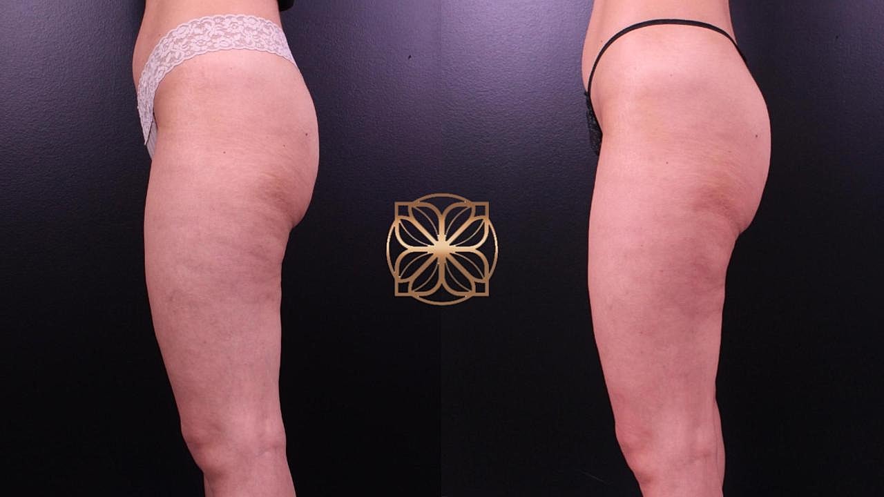 Coolsculpting Gallery Before & After