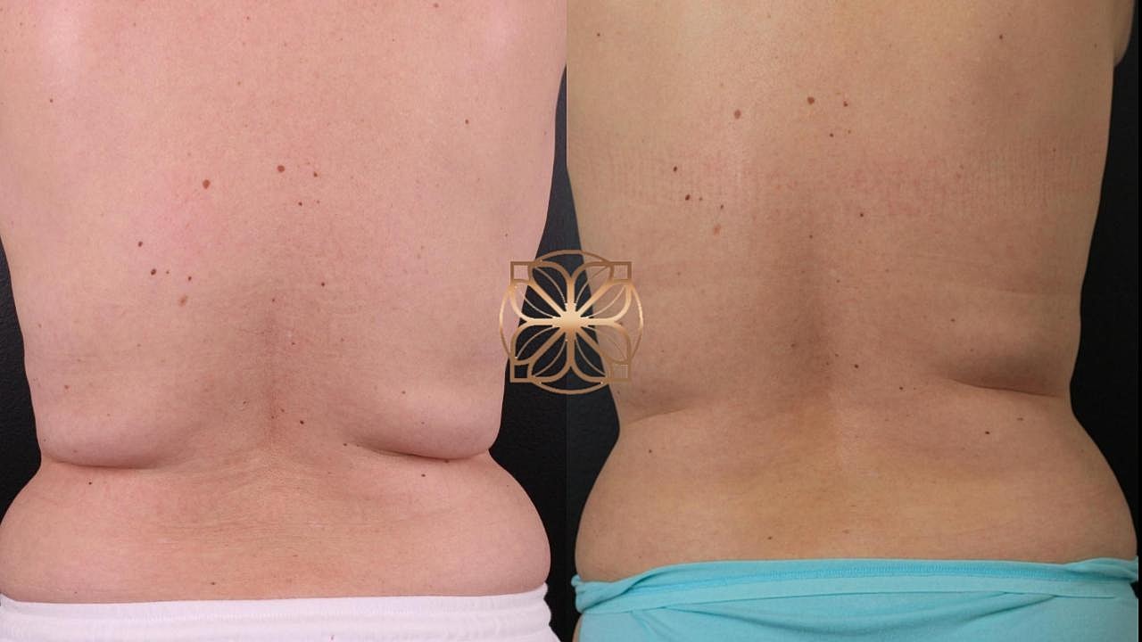 Coolsculpting Gallery Before & After