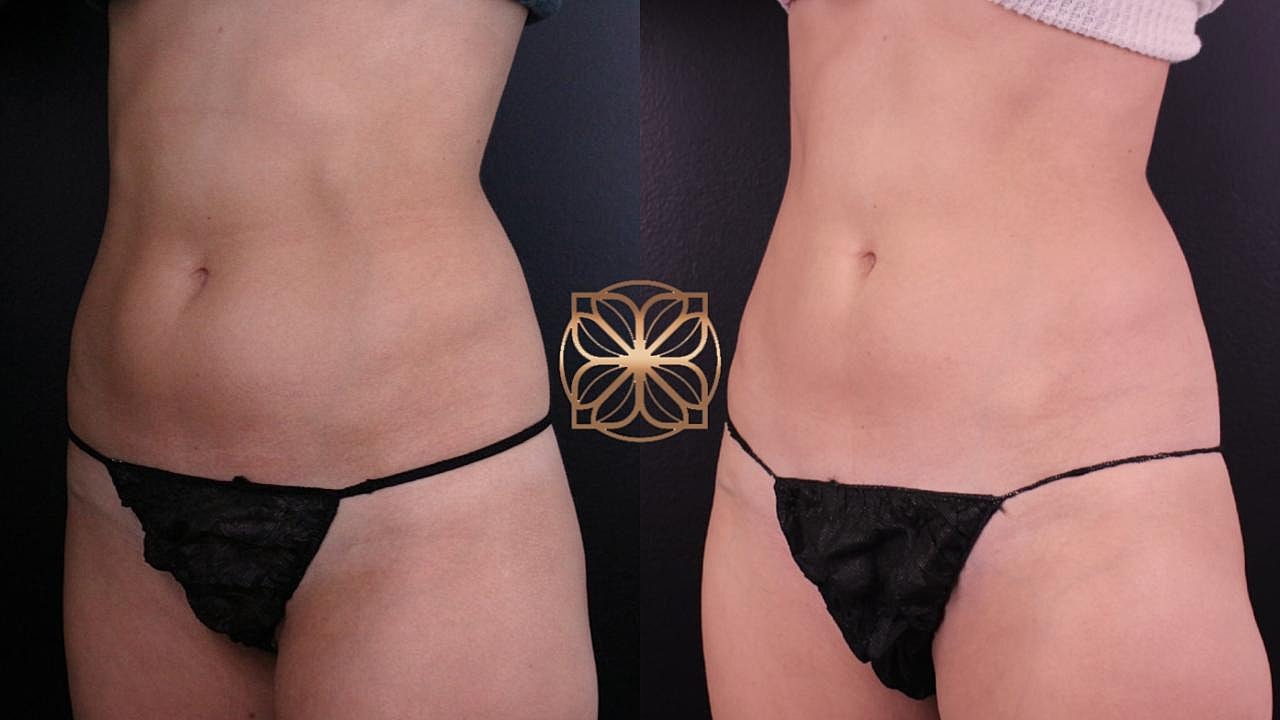 Coolsculpting Gallery Before & After