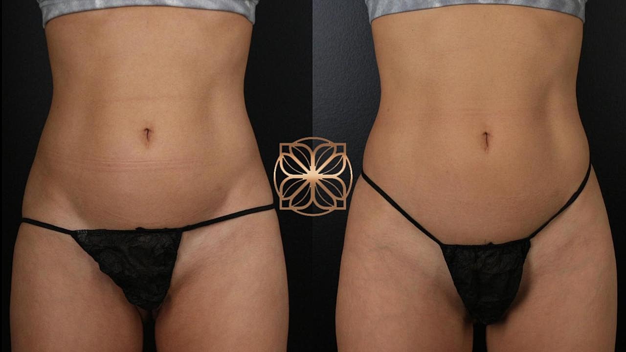 Coolsculpting Gallery Before & After