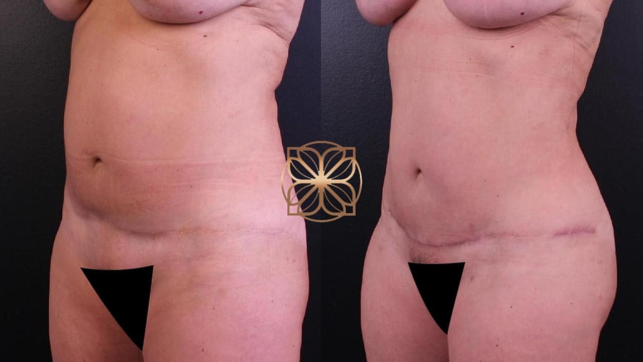 Coolsculpting Gallery Before & After