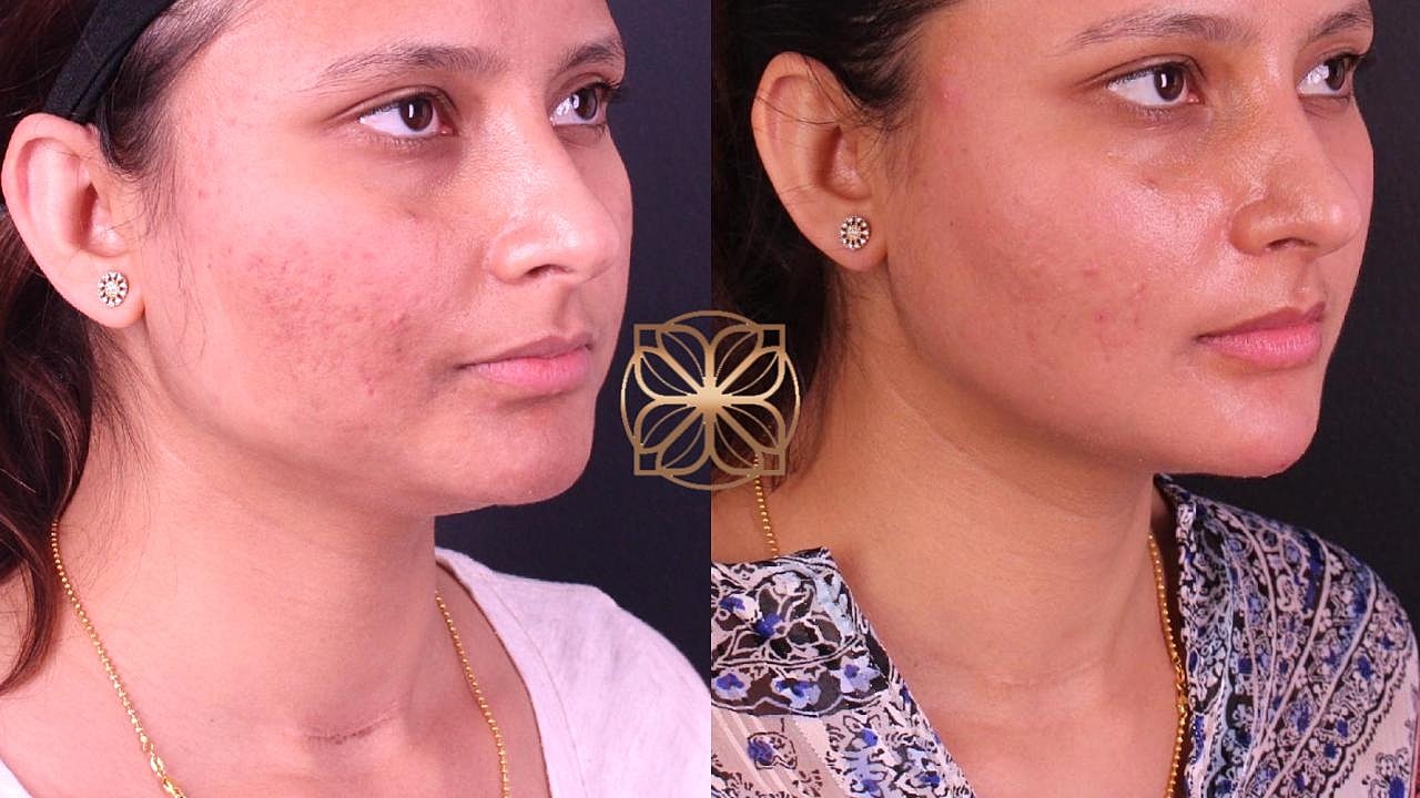 Laser Gallery Before & After