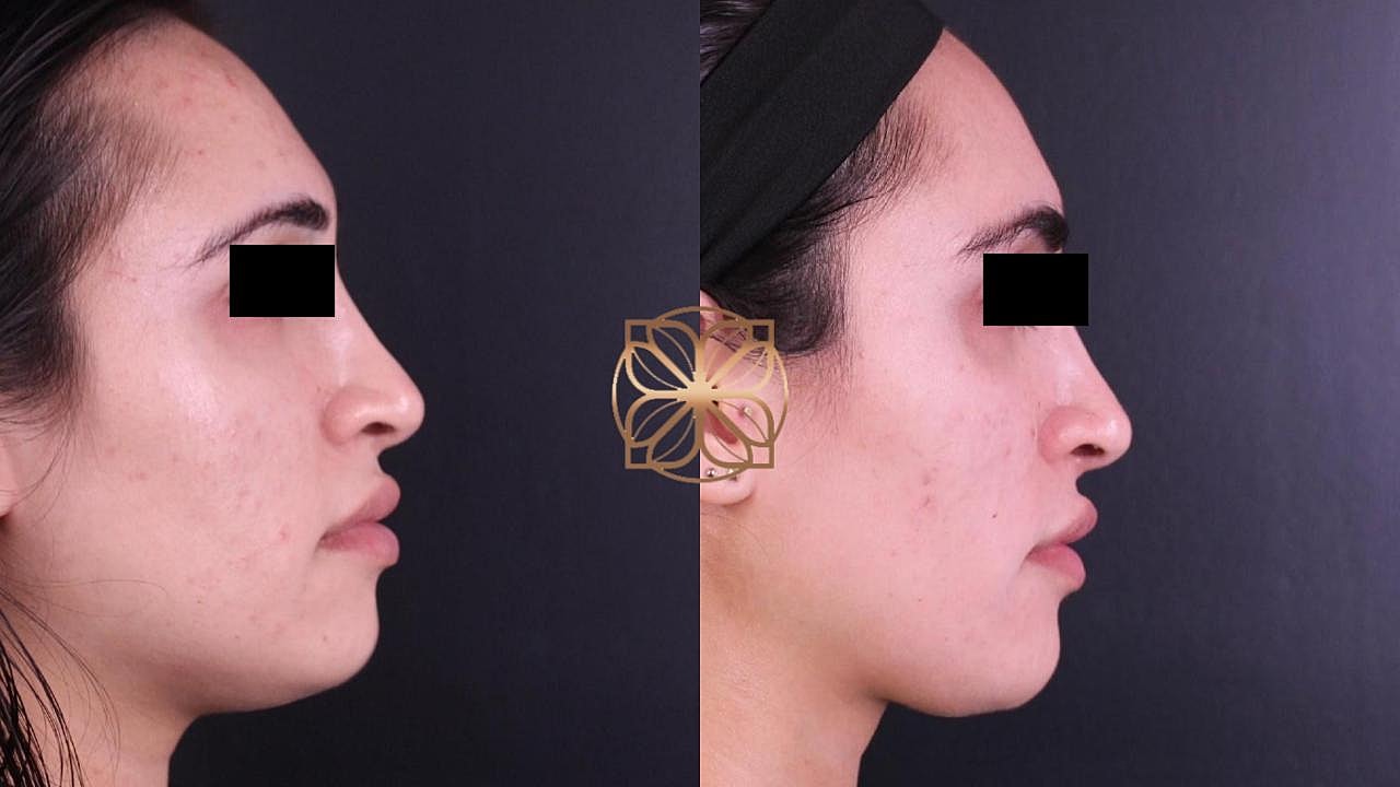 Laser Gallery Before & After