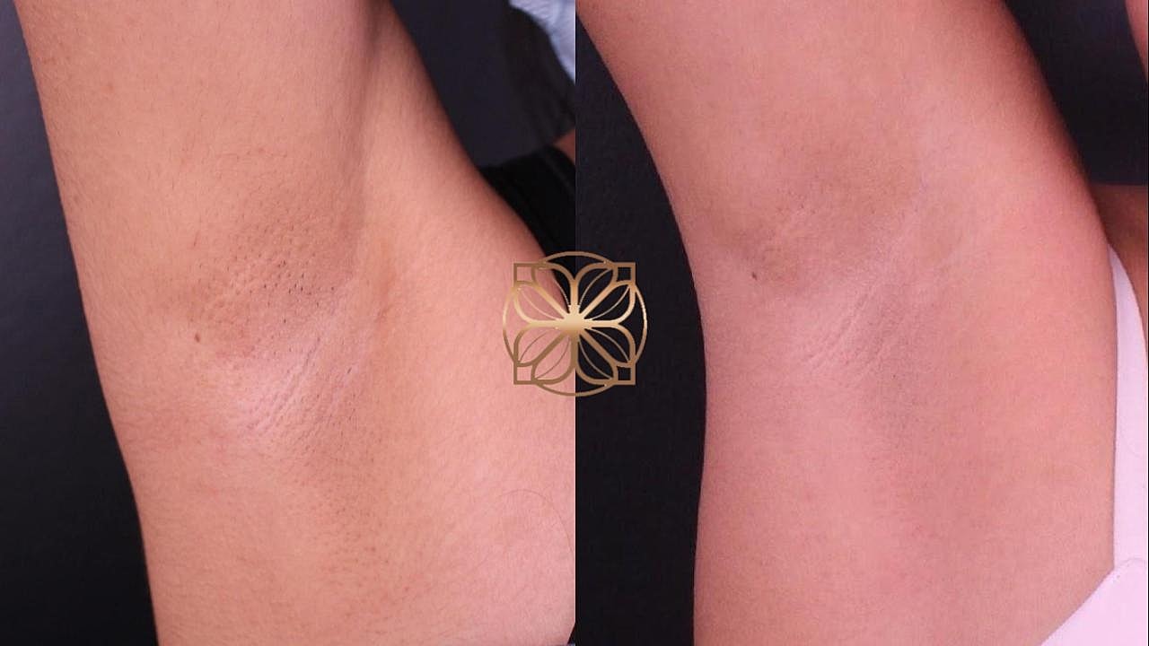 Laser Gallery Before & After