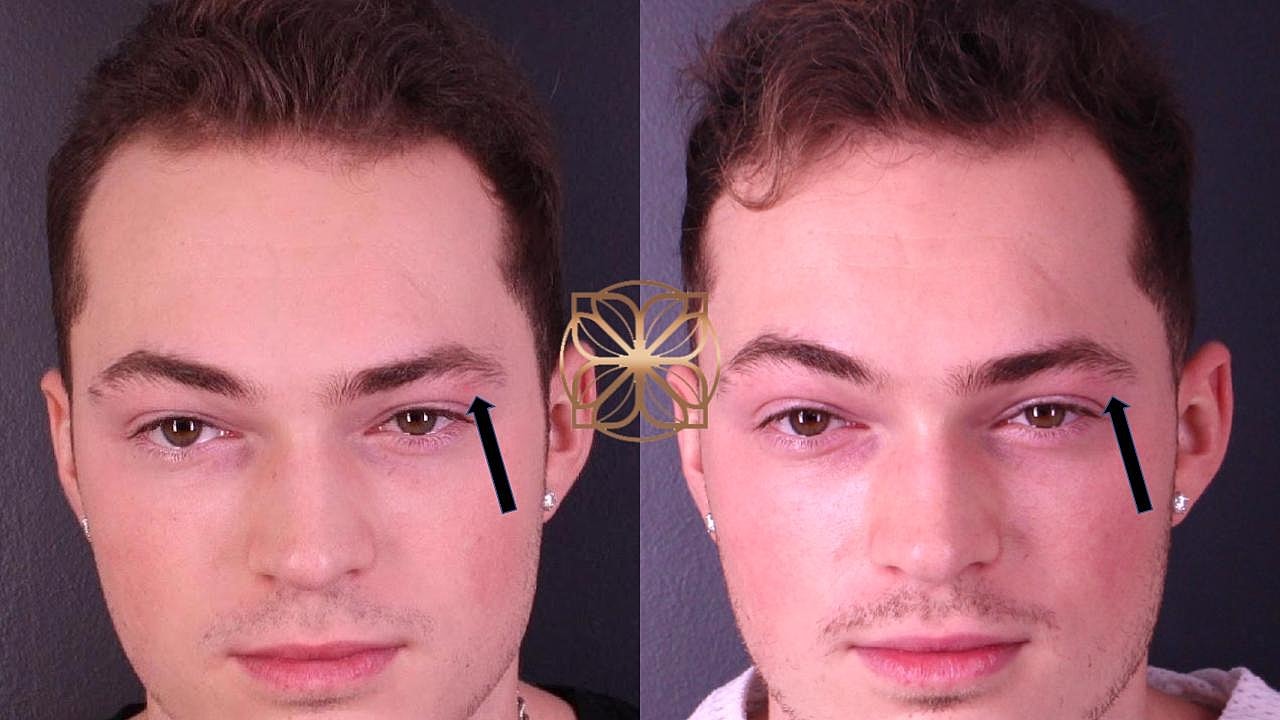 Laser Gallery Before & After