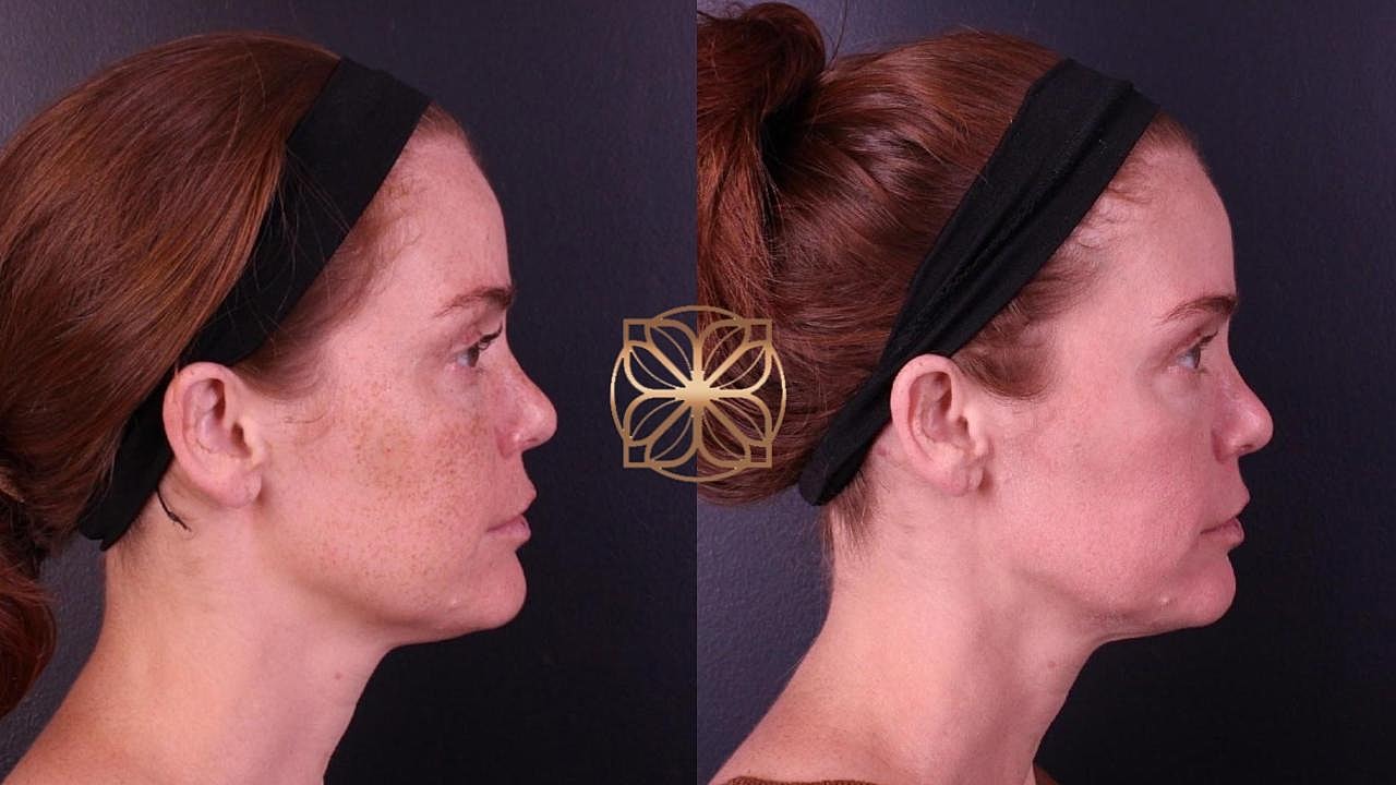 Skin Rejuvenation Gallery Before & After