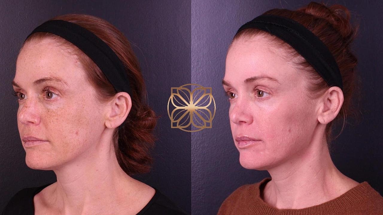 Skin Rejuvenation Gallery Before & After