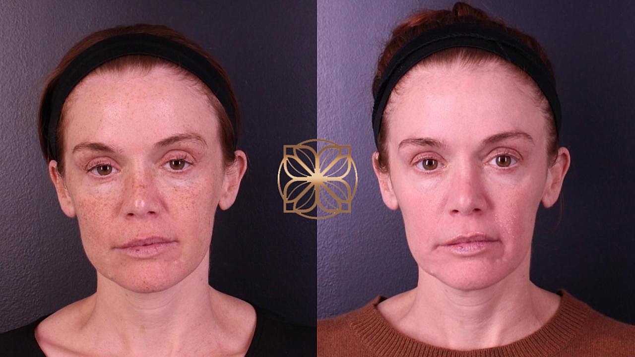 Skin Rejuvenation Gallery Before & After