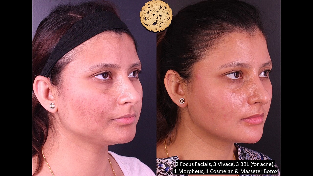 Skin Rejuvenation Gallery Before & After