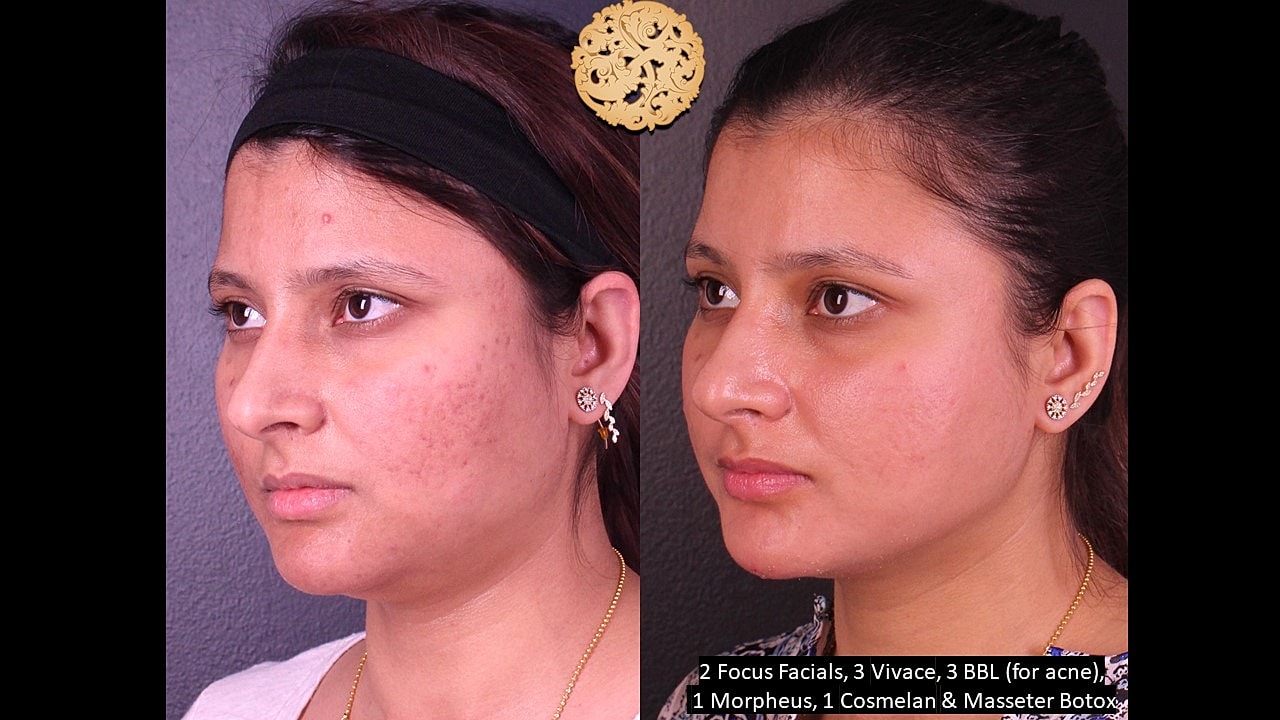 Skin Rejuvenation Gallery Before & After