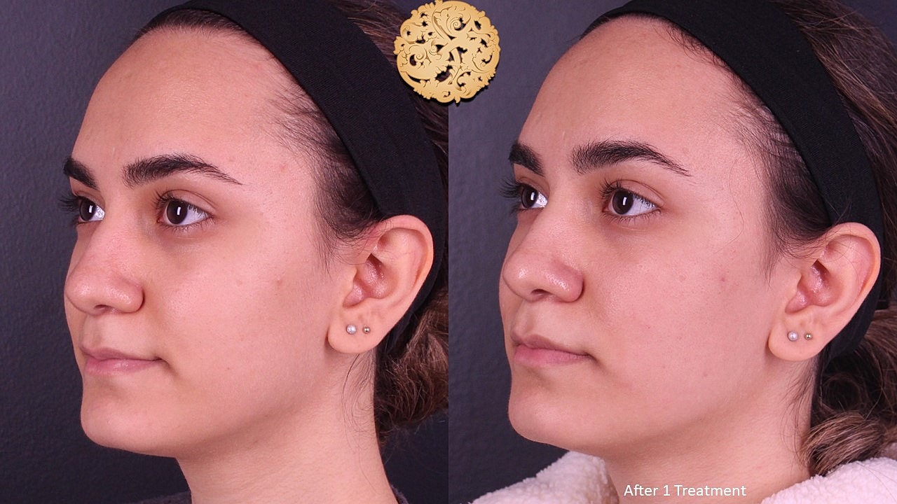 Skin Rejuvenation Gallery Before & After
