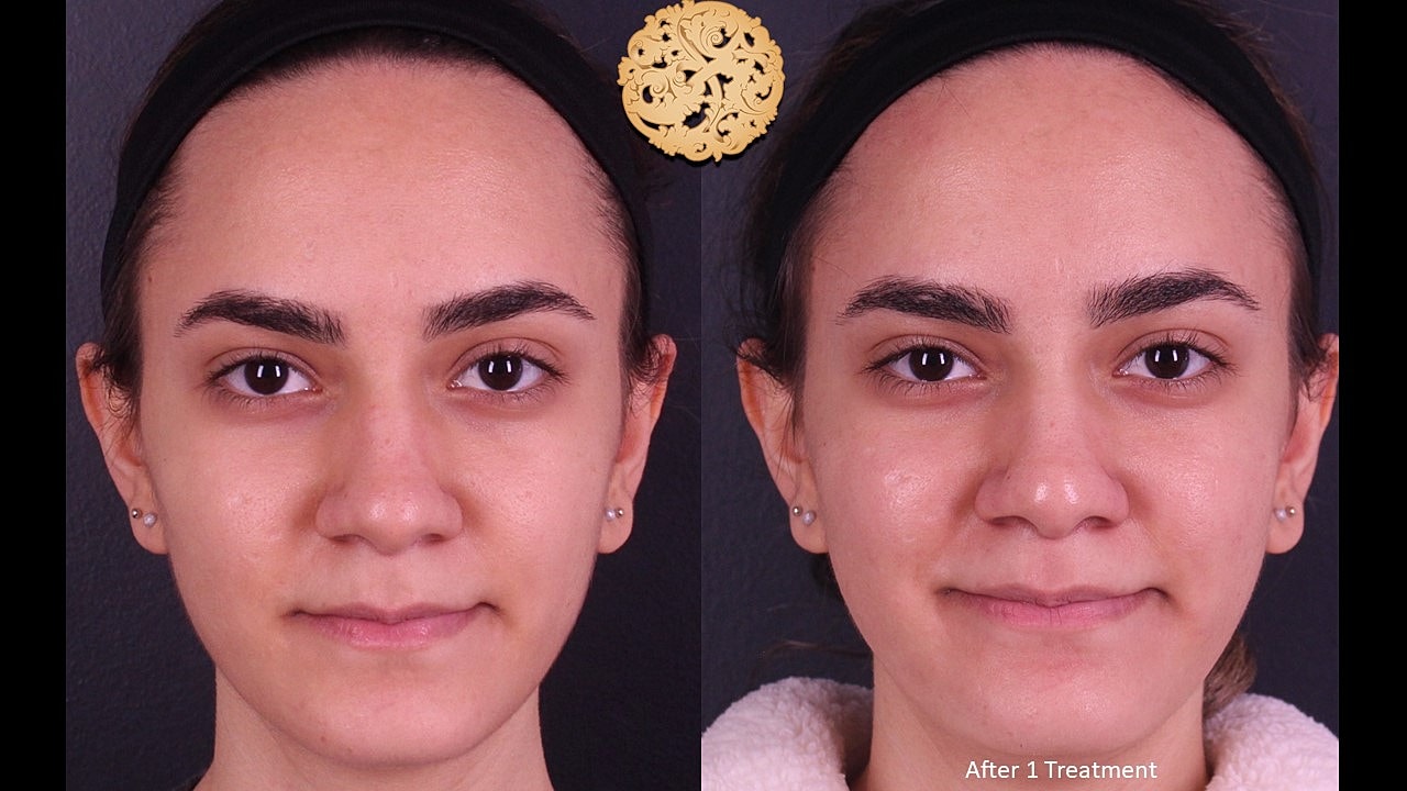 Skin Rejuvenation Gallery Before & After