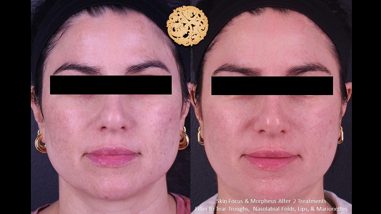 Skin Rejuvenation Gallery Before & After