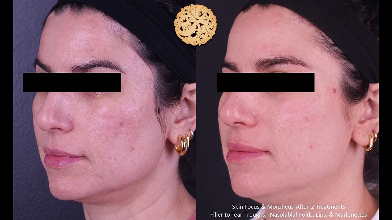Skin Rejuvenation Gallery Before & After