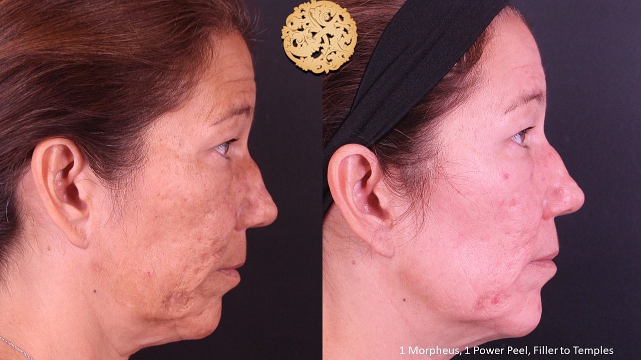 Skin Rejuvenation Gallery Before & After
