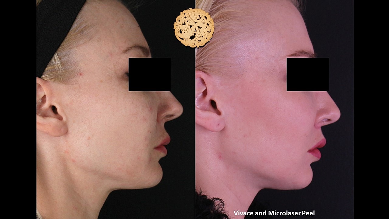 Skin Rejuvenation Gallery Before & After