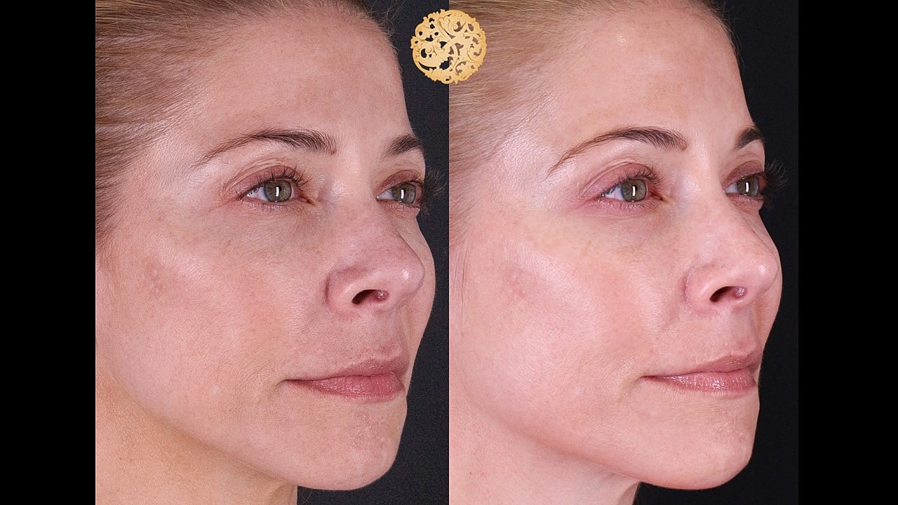 Skin Rejuvenation Gallery Before & After