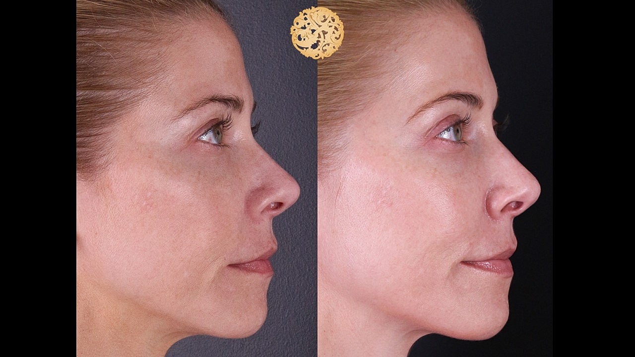 Skin Rejuvenation Gallery Before & After