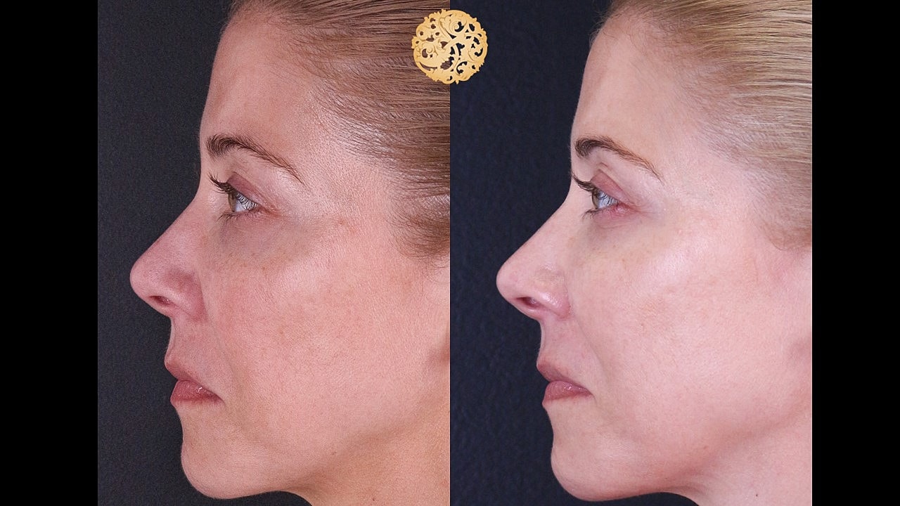 Skin Rejuvenation Gallery Before & After