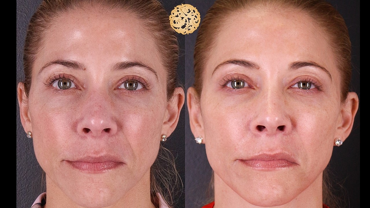 Skin Rejuvenation Gallery Before & After