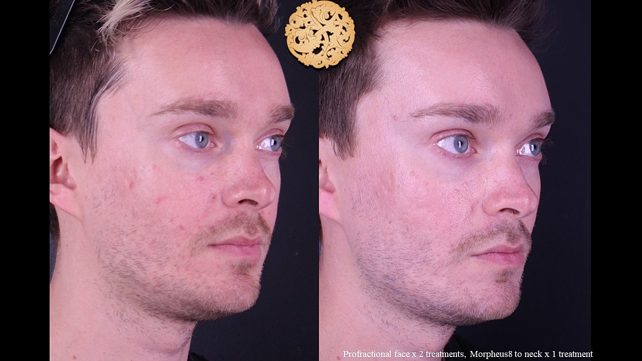 Skin Rejuvenation Gallery Before & After
