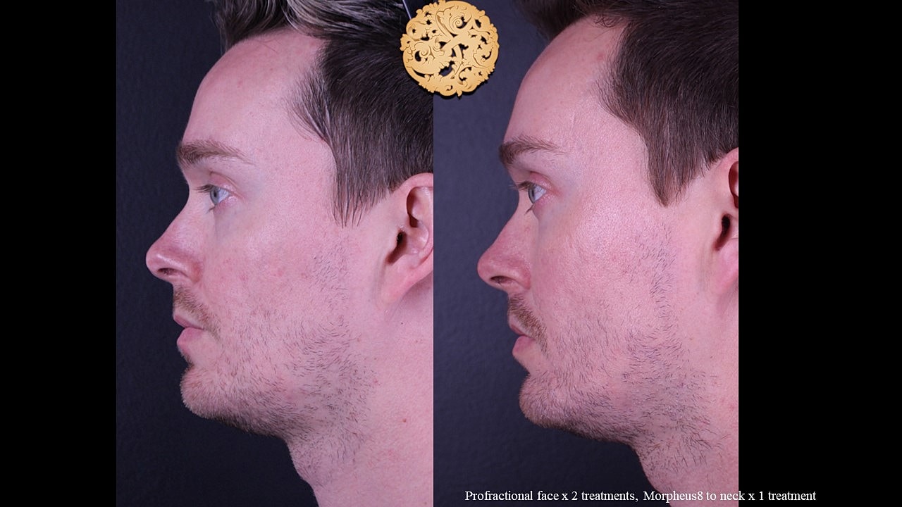 Skin Rejuvenation Gallery Before & After