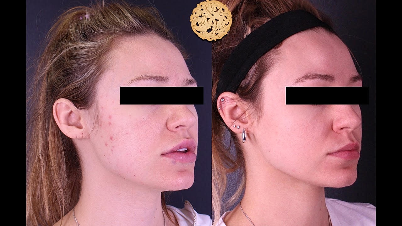 Skin Rejuvenation Gallery Before & After