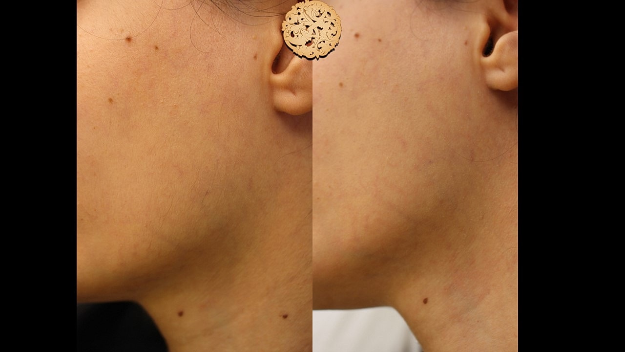 Skin Rejuvenation Gallery Before & After