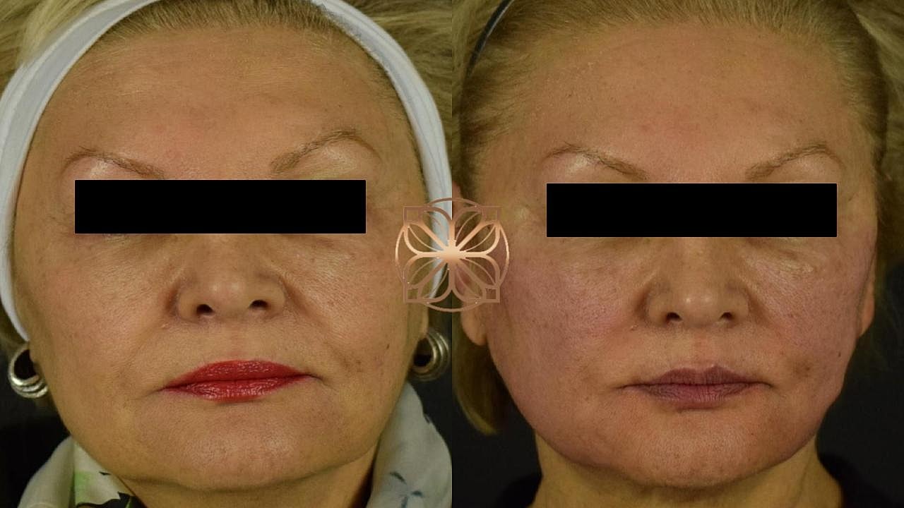 Skin Rejuvenation Gallery Before & After