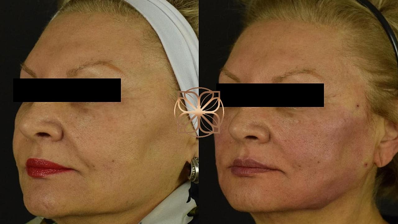 Skin Rejuvenation Gallery Before & After