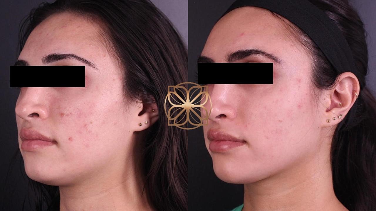 Skin Rejuvenation Gallery Before & After