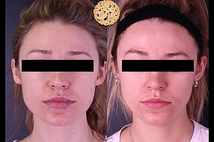 Skin Rejuvenation Gallery Before & After