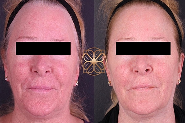 Skin Rejuvenation Gallery Before & After