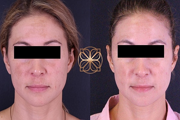 Skin Rejuvenation Gallery Before & After