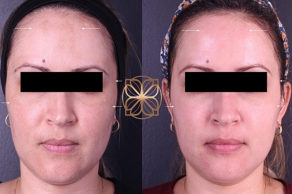 Skin Rejuvenation Gallery Before & After