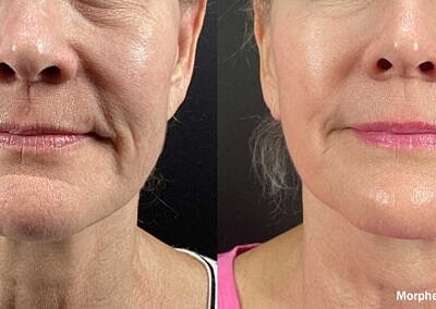 Skin Rejuvenation Gallery Before & After
