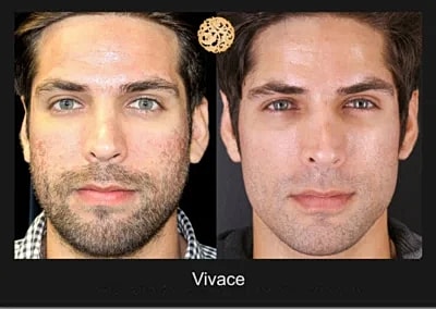 Skin Rejuvenation Gallery Before & After