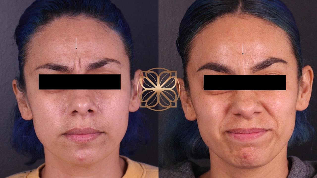 Injectables Gallery Before & After