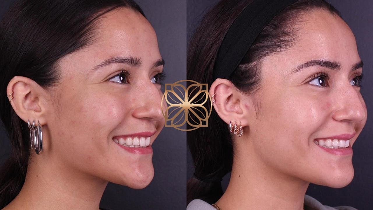 Injectables Gallery Before & After