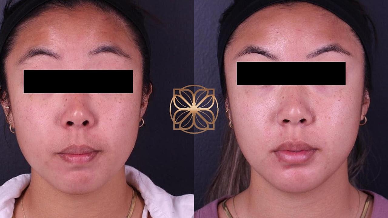 Injectables Gallery Before & After