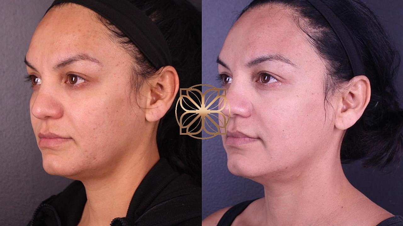 Injectables Gallery Before & After
