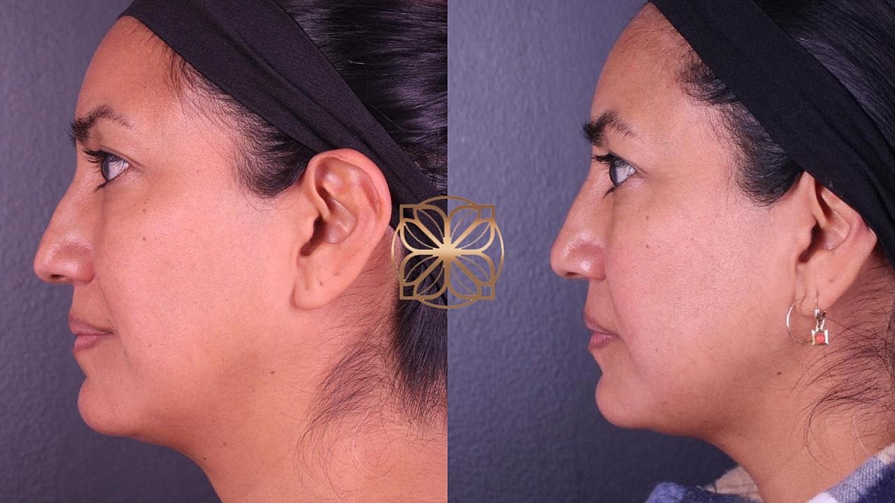 Injectables Gallery Before & After