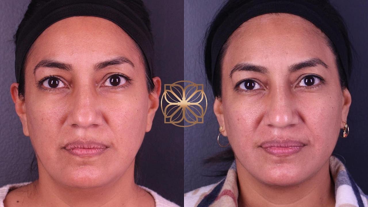 Injectables Gallery Before & After