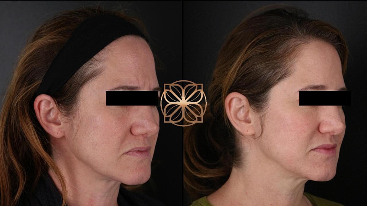 Injectables Gallery Before & After