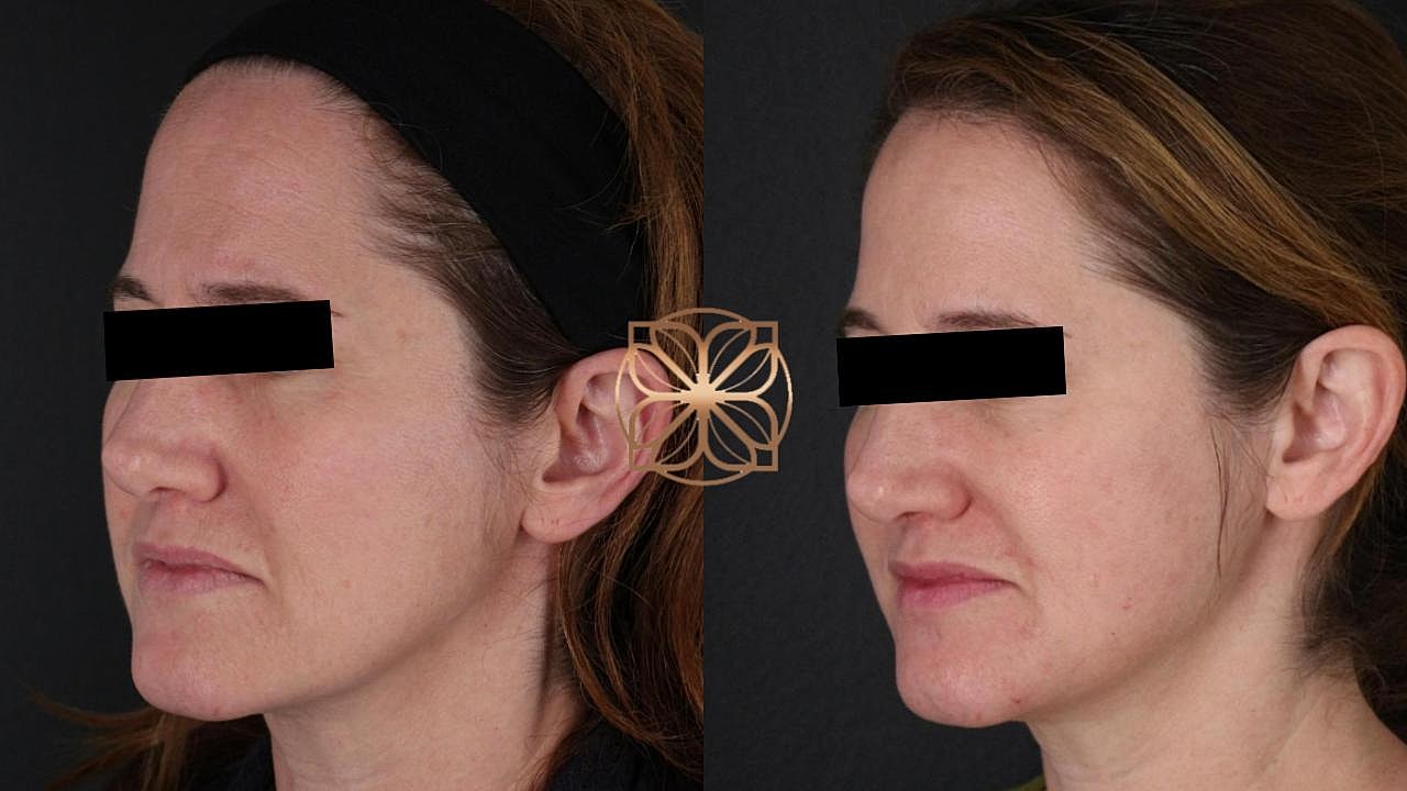 Injectables Gallery Before & After