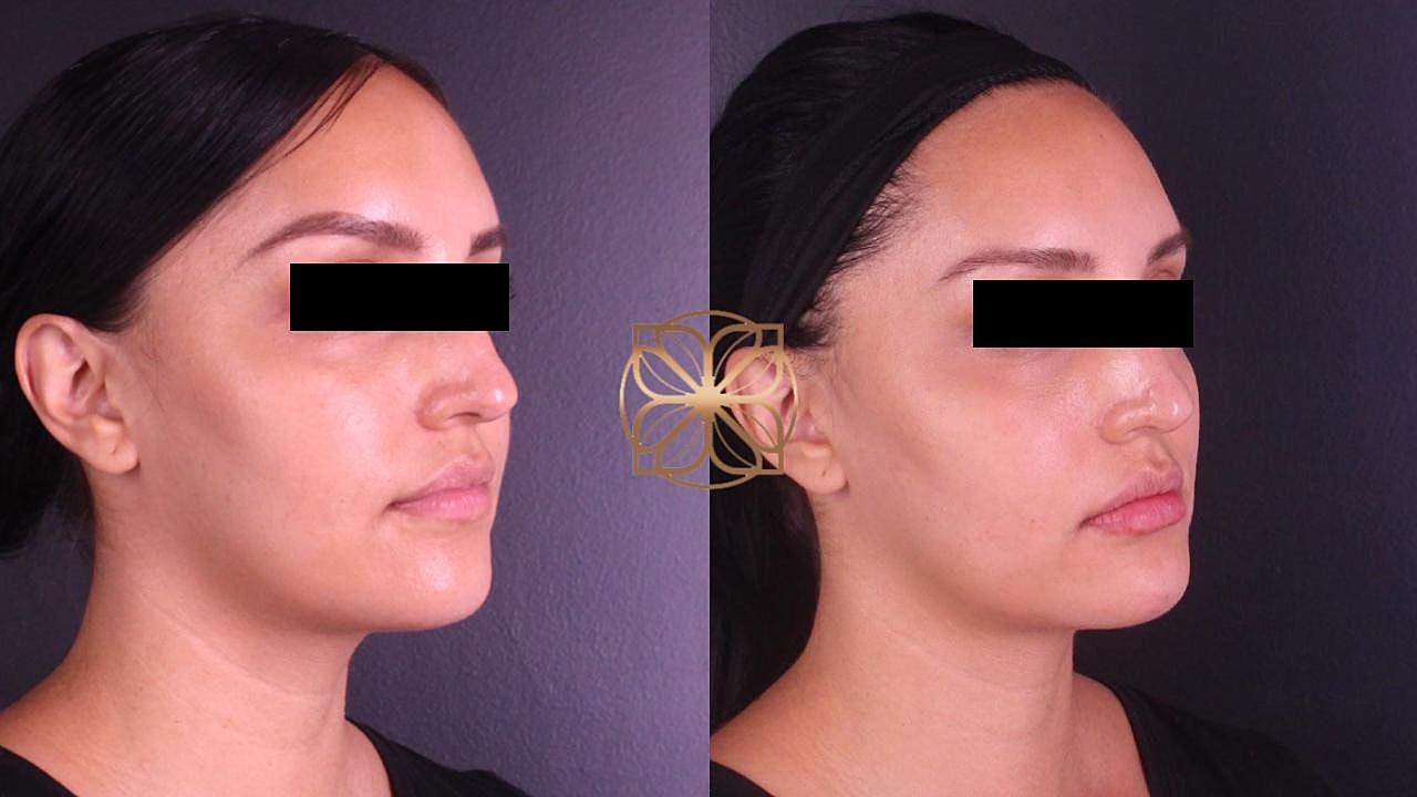 Injectables Gallery Before & After