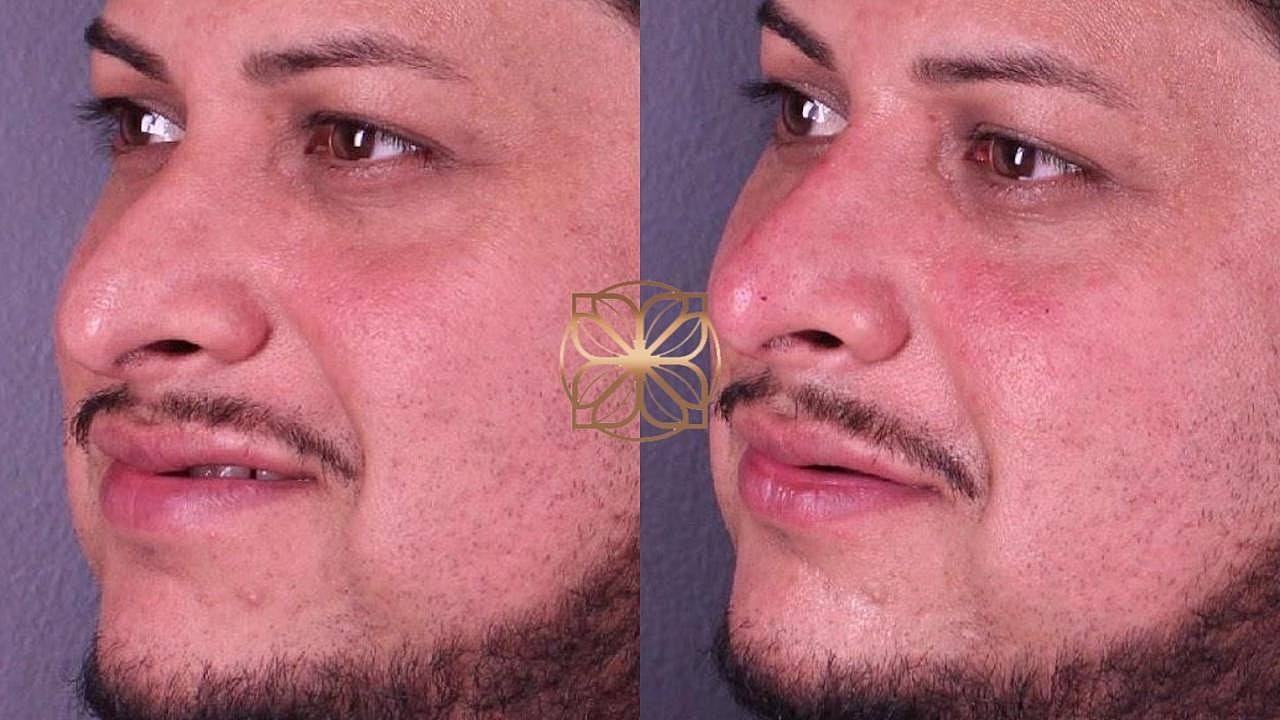 Injectables Gallery Before & After